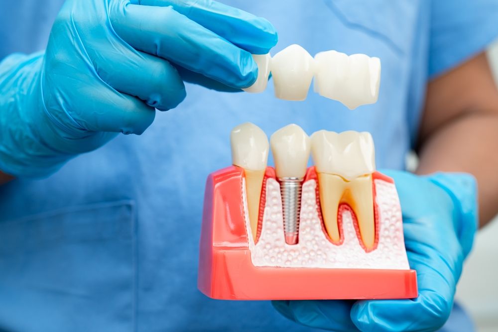 Dental implant, artificial tooth roots into jaw, root canal of dental treatment