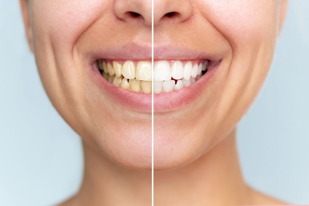 Young woman before and after teeth whitening close-up